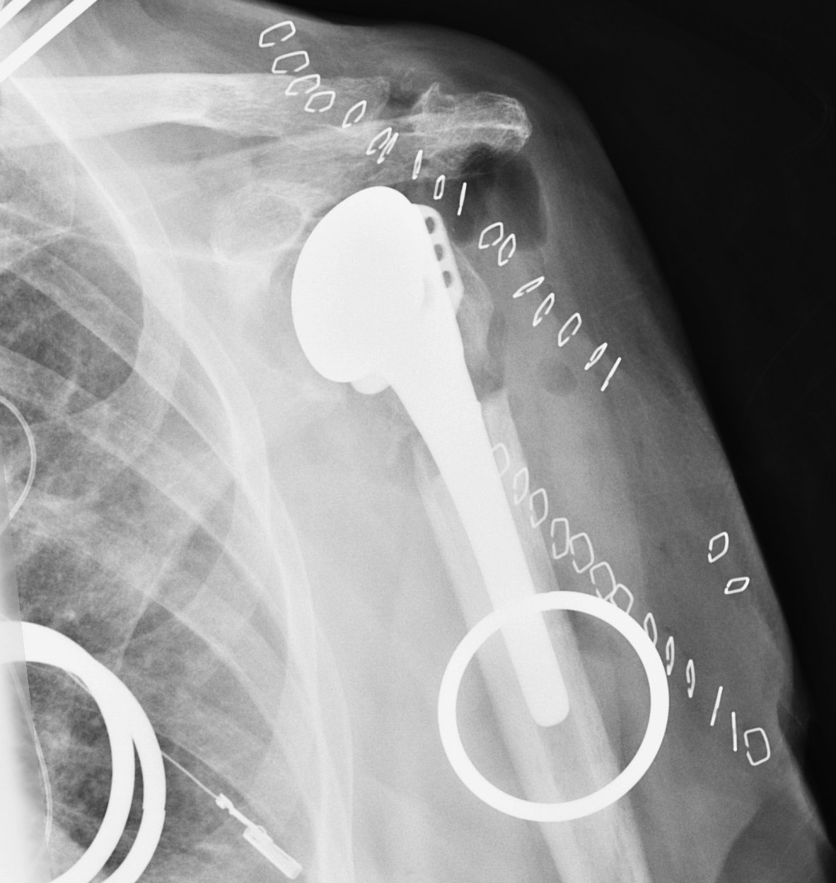 Revision for Posterior Dislocation TSR Combined Anterior Posterior Approach